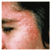 Eficienta BLUE CAP Crema si Sampon in unele Dermatoze Inflamatorii