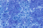 VIUSID - preparat nutritional ortomolecular antiviral, ce prezinta efect antifibrozant hepatic marcant  atunci cand este administrat corespunzator.