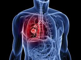 Japonia este pe cale sa puna la punct un test sangvin prin care se depisteaza 13 dintre cele mai frecvente cancer! - 04.09.2014