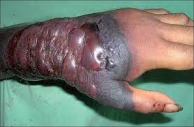 EBOLA. Preventie si la nivel personal...
