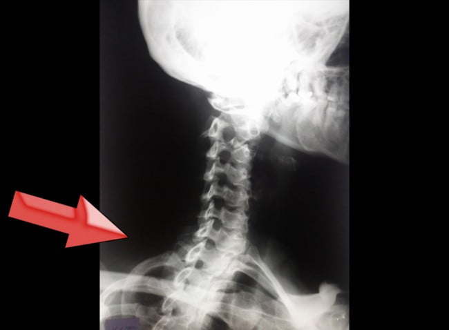 Stiati ca...SPONDILOZA CERVICALA are ca si principale simptome...?!